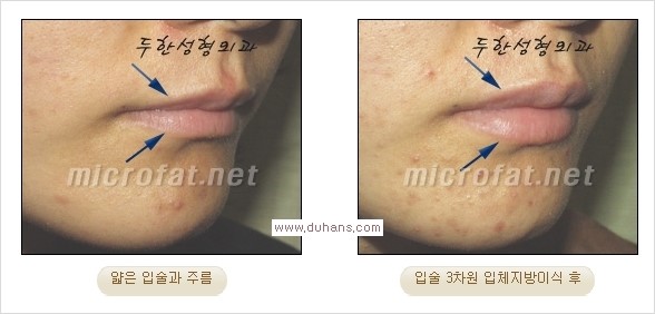 [두한성형외과 경쟁력 미세지방이식] - [입술 3차원 입체지방이식 안내 2.] 관련 이미지 2