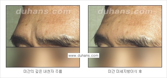 [두한성형외과 경쟁력 주름성형] - [지방이식을 이용한 이마주름, 미간주름 제거] 관련 이미지 13