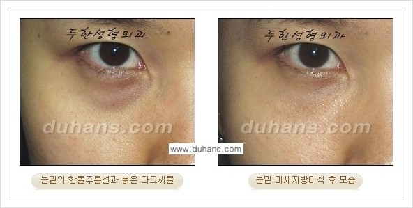 [두한성형외과 경쟁력 눈밑성형] - [꺼진 눈밑, 눈밑 함몰 주름선 눈밑 미세지방이식 안내] 관련 이미지 16