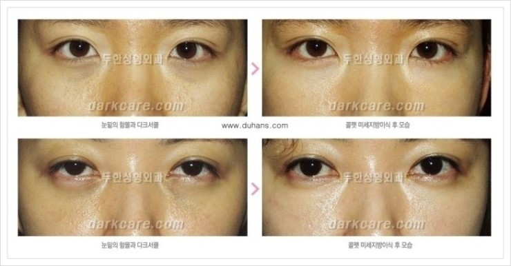 [두한성형외과 경쟁력 눈밑성형] - [눈밑이 전반적으로 함몰된 다크써클 교정 안내] 관련 이미지 15