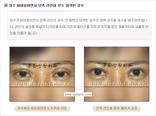 [두한성형외과 경쟁력 눈성형] - [비대칭(짝짝이) 쌍꺼풀 라인 교정 안내 ②] 관련 이미지 4