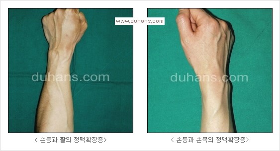 [두한성형외과 경쟁력 정맥류 치료] - [정맥류 치료의 모든 것] 관련 이미지 25