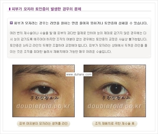 [두한성형외과 경쟁력 쌍꺼풀 재수술(극한 재수술)] - [쌍꺼풀 재수술에서 극복해야 할 여러 가지 상황과 문제점들 안내] 관련 이미지 6