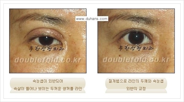 [두한성형외과 경쟁력 쌍꺼풀 재수술, 극한 재수술] - [망가진 눈 복원수술 - 속눈썹 외반 교정 안내] 관련 이미지 6