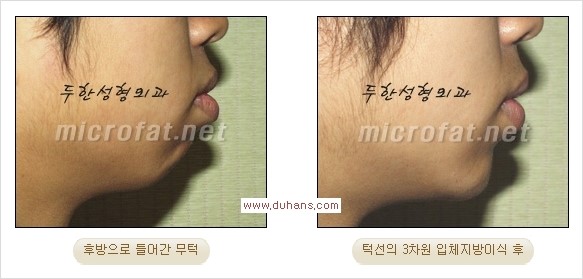 [두한성형외과 경쟁력 미세지방이식] - [부드럽고 아름다운 얼굴윤곽선 턱(하악부) 미세지방이식 안내] 관련 이미지 25