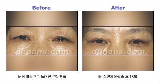 [두한성형외과 경쟁력 안검성형] - [상큼하고 환한 눈매의 완성 상안검 성형술 안내] 관련 이미지 9