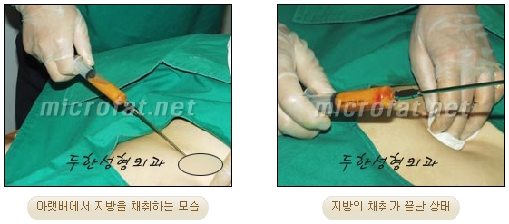 [Duhan Plastic Surgery Face Autologous Fat Grafting] - [Noble Surgery and Indian Band Fat Grafting] image 12