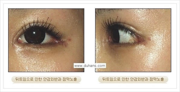 [두한성형외과 경쟁력 쌍꺼풀 재수술, 극한 눈재수술] - [뒤트임 수술의 부작용 및 교정 방법 안내] 관련 이미지 5