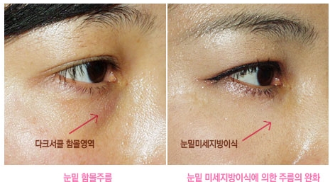 [두한성형외과 다크서클] - [콜펫지방이식] 관련 이미지 18
