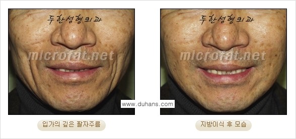 [두한성형외과의 경쟁력 있는 지방이식] - [입가주름, 팔자주름 미세지방이식 1.] 관련 이미지 14
