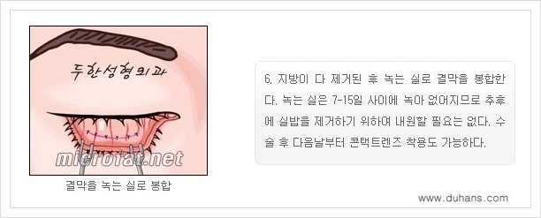 [두한성형외과 경쟁력 지방제거] - [눈밑(눈위)지방제거, 눈꺼풀(윗눈꺼풀)지방제거 안내 ①] 관련 이미지 10