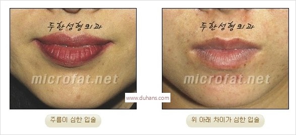 ​​​[두한성형외과 경쟁력 지방이식] - [지방이식을 이용한 입술성형 안내] 관련 이미지 1