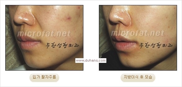 [두한성형외과 경쟁력 주름성형] - [주름 교정을 위한 안전하고 효과적인 미세지방이식] 관련 이미지 12