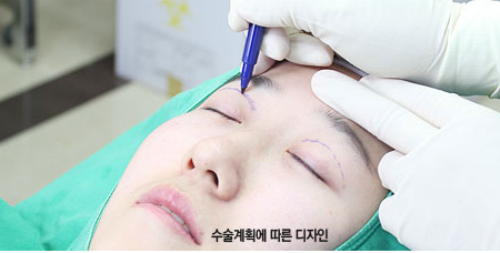 [눈밑수술 두한성형외과] - [다크서클 콤비프로그램] 관련 이미지 45