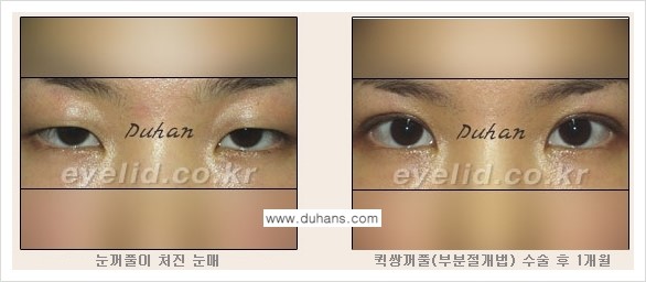 [두한성형외과 NO.1 눈성형] - [절개법과 매몰법 관련 흔한 질문과 답변] 관련 이미지 2