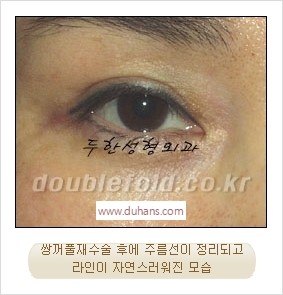 [두한성형외과 경쟁력 쌍꺼풀 재수술 리더] - [풀린 쌍꺼풀, 풀려버린 쌍꺼풀 재수술 방법 안내] 관련 이미지 13