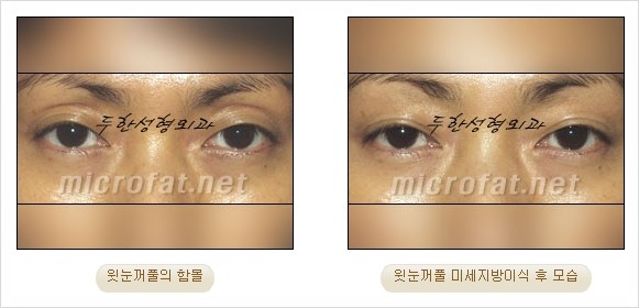 [두한성형외과 경쟁력 지방이식 리더] - [Col-fat(콜펫)지방이식, 3차원 입체지방이식, 2차원 평면지방이식] 관련 이미지 62
