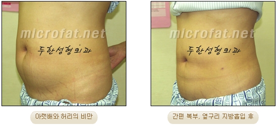 두한성형외과 지방흡입 - 부위별 안전 지방흡입 관련 이미지 14