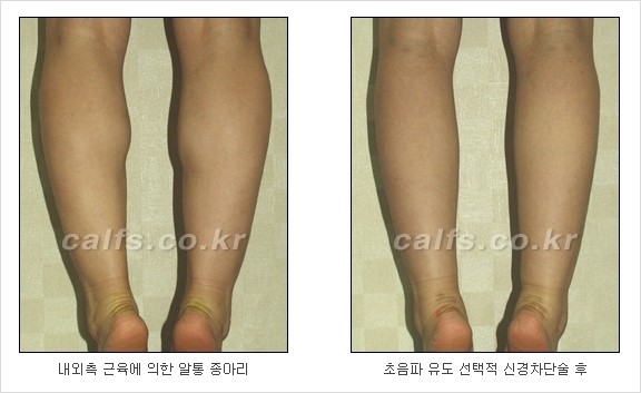 [두한성형외과 경쟁력 종아리성형] - [초음파 유도 선택적 신경차단술 안내 ④] 관련 이미지 6