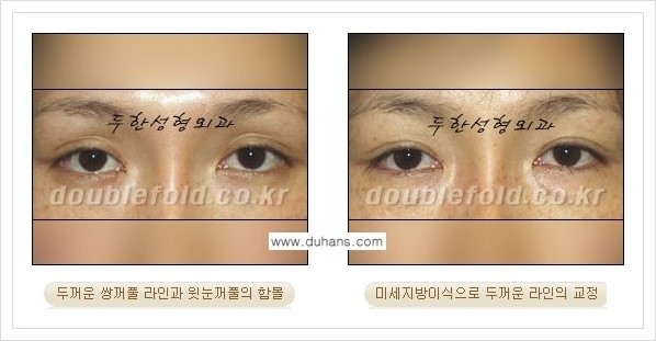 [두한성형외과 경쟁력 눈성형] - [미세지방이식으로 두껍고 어색한 라인 교정 안내 1.] 관련 이미지 9