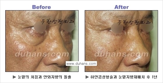 [두한성형외과의 상큼하고 환한 젊은 눈매완성] - [하안검 성형술 ②] 관련 이미지 27