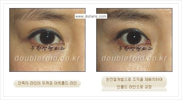 [두한성형외과 경쟁력 쌍꺼풀 재수술, 극한 눈재수술] - [심한 아웃폴드 쌍꺼풀 라인 재수술 방법] 관련 이미지 3