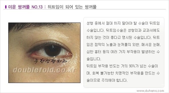 [두한성형외과 경쟁력 쌍꺼풀 재수술, 극한 눈재수술] - [Dr. 컬럼 - 재수술의 목표] 관련 이미지 16