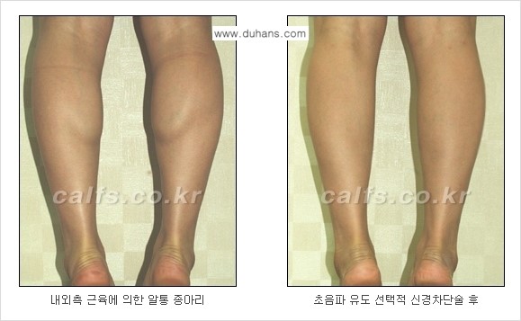 ​[두한성형외과와 날씬한 종아리 만들기!] - [간편하고 안전한 종아리 축소방법 ④] 관련 이미지 9