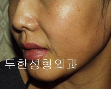 [두한성형외과 지방이식] - [타병원의 지방이식 부작용 교정] 관련 이미지 39