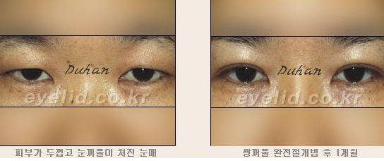 [두한성형외과 쌍커풀수술] - [눈성형 방법에 대한 자주하는 질문과 답변] 관련 이미지 133