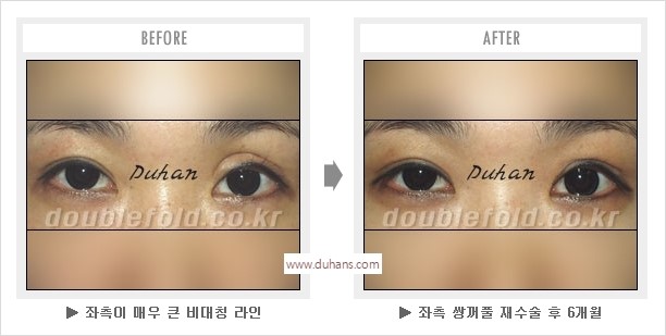 [두한성형외과 경쟁력 눈성형] - [나에게 맞는 어울리는 쌍꺼풀 라인] 관련 이미지 46