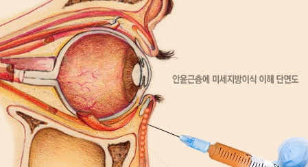 [두한성형외과 다크서클] - [콜펫지방이식] 관련 이미지 14
