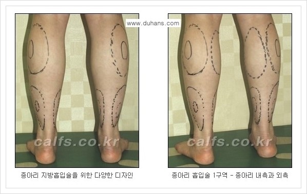 [두한성형외과 경쟁력 멀티종아리성형] - [나에게 맞는 종아리 시술 방법과 종류 안내 ②] 관련 이미지 2
