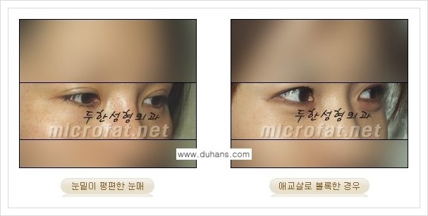 [두한성형외과 경쟁력 눈밑성형] - [애교살과 다크써클과의 관계] 관련 이미지 3