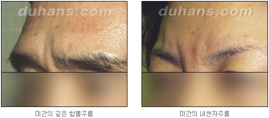 [두한성형외과 주름교정] - [주름개선 지방이식] 관련 이미지 5