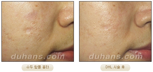 [DuHan Plastic Surgery Scar] - [DHL Simple Scar Treatment] image 14