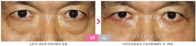 [두한성형외과 다크서클] - [다크서클 전후사진 검증] 관련 이미지 137