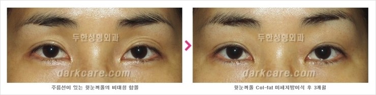 [두한성형외과 경쟁력 눈밑 다크써클 치료] - [눈밑 다크써클과 눈위 지방이식 콤비 프로그램 안내] 관련 이미지 12