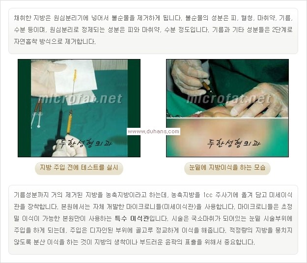 [두한성형외과 경쟁력 눈밑성형] - [눈밑 미세지방이식으로 다크써클 치료] 관련 이미지 9