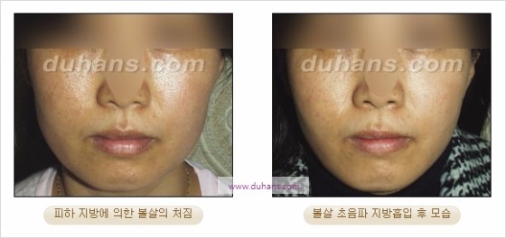 [두한성형외과 경쟁력 지방흡입] - [볼살, 턱선의 간편 지방흡입] 관련 이미지 14