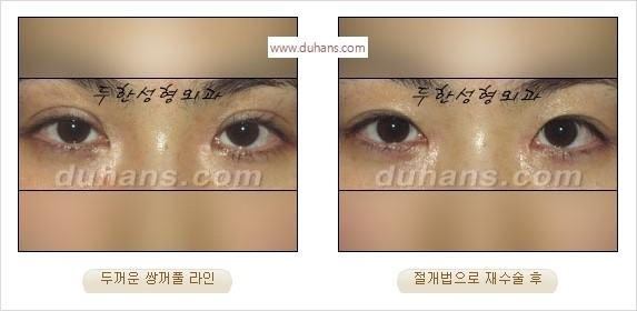 [두한성형외과 경쟁력 눈성형] - [나에게 맞는 어울리는 쌍꺼풀 라인] 관련 이미지 8