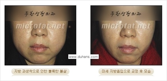 [두한성형외과 경쟁력 미세지방이식] - [타 병원에서 볼살 지방이식 이후 부작용 교정 방법 안내] 관련 이미지 14