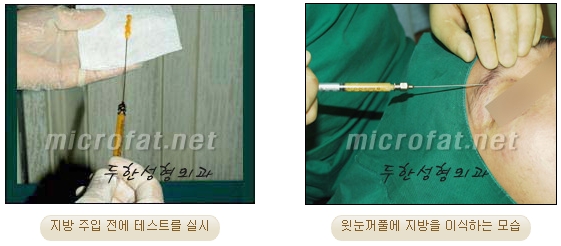 [Doohan Plastic Surgery Autologous Fat Grafting] - [Sunken Eye Fat Grafting] image 8