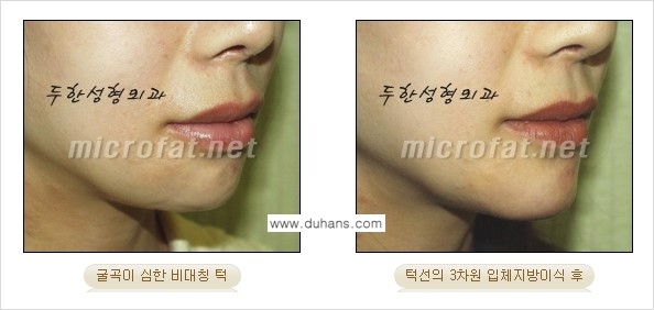 [두한성형외과의 경쟁력 미세지방이식] - [무턱교정 - 턱 미세지방이식 안내 2.] 관련 이미지 18