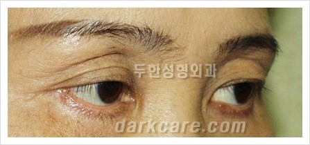 [두한성형외과 경쟁력 눈밑성형] - [다크써클 + 눈위 지방이식 콤비 프로그램] 관련 이미지 3