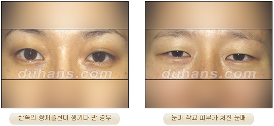 [Duhan Plastic Surgery Double Eyelid Surgery] - [Double Eyelid Guide] image 1