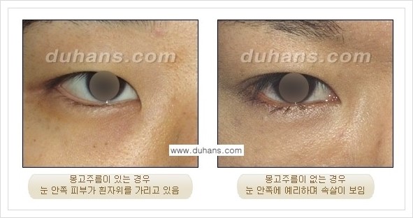 [두한성형외과 경쟁력 눈성형] - [앞트임 수술(몽고주름 제거) 안내 ①] 관련 이미지 2