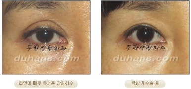 [Special Double Eyelid Revision Surgery at Duhan Plastic Surgery] - [Restorative Surgery for Damaged Double Eyelid Eye Shape] image 25