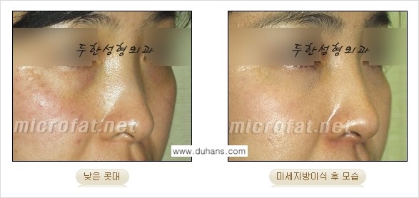 ​[두한성형외과의 No.1 경쟁력 미세(자가)지방이식] - [코높힘 미세(자가)지방이식 ②] 관련 이미지 13