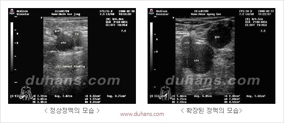 [두한성형외과 경쟁력 정맥류 치료] - [정맥류 치료의 모든 것] 관련 이미지 3